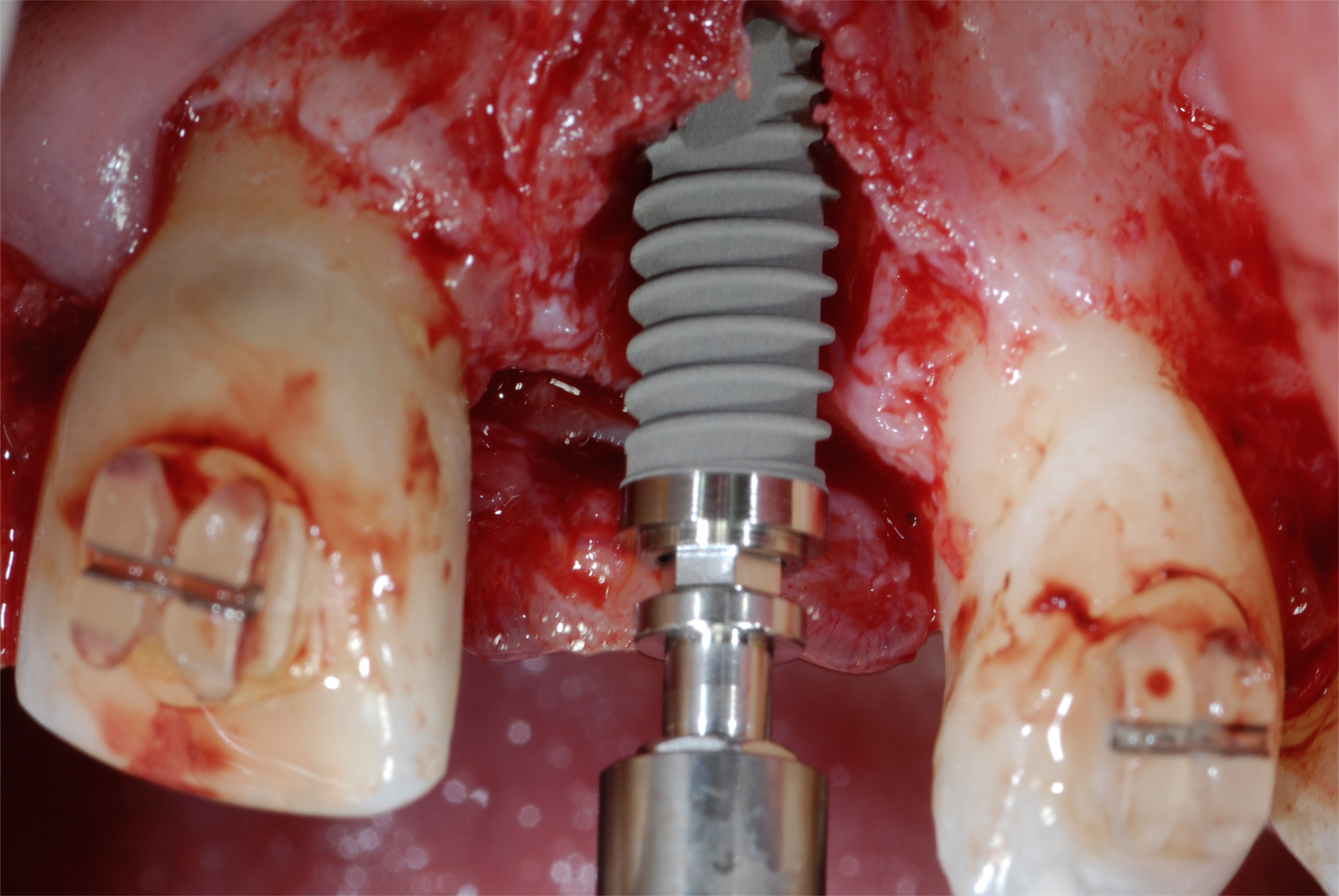 牙周膜龈手术+植骨（PAOO）记录 - 知乎
