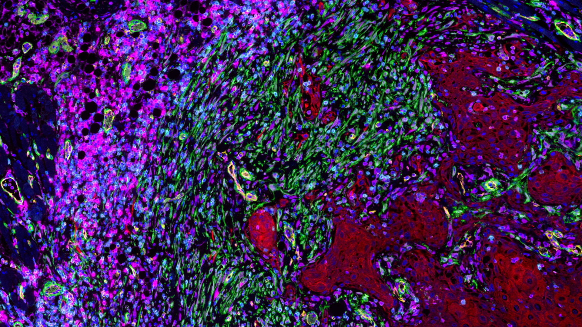 带有6种细胞特异性抗原标记的口腔癌组织。样品：N. Gaßler / A. Berndt / D. Samsel，耶拿大学医院病理科 