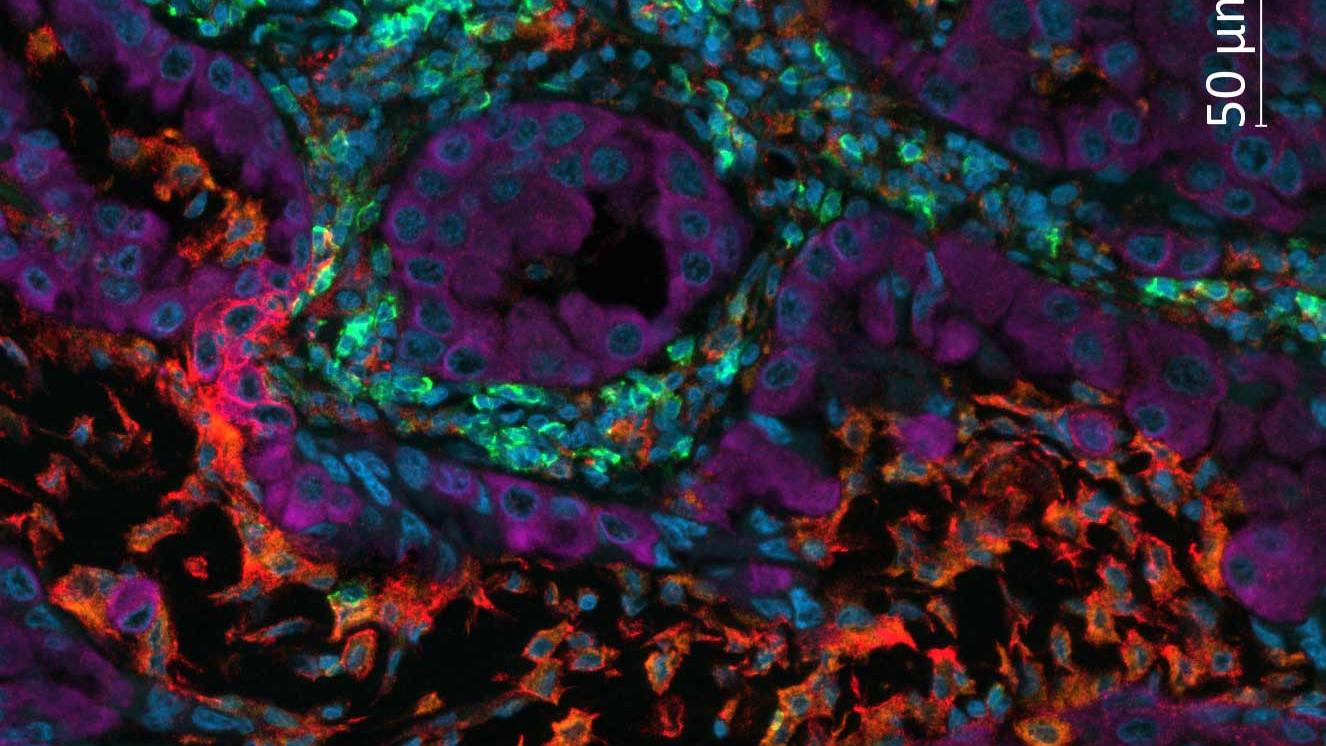 用UltiMapper I/O PD-L1试剂盒染色的非小细胞肺癌（NSCLC）组织。细胞核（蓝色），CD8（绿色），CD68（橙色），PD-L1（红色），广谱细胞角蛋白（品红色）。 