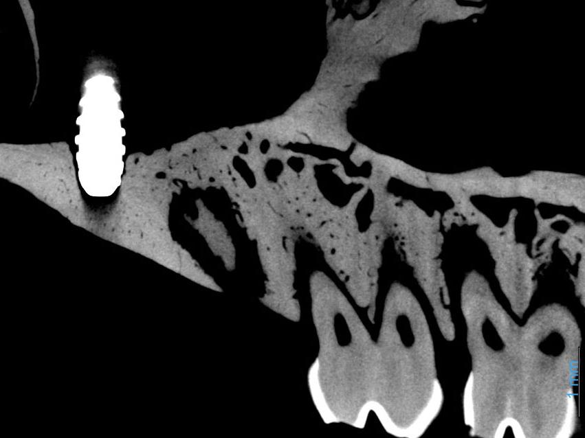 Biomedical metal implant in bone. Without MARS, left. With MARS, right.​