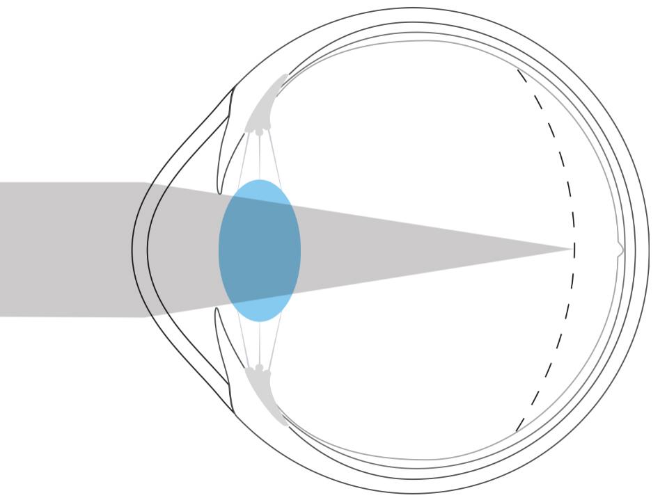 近视眼的图示显示光线集中在视网膜前。