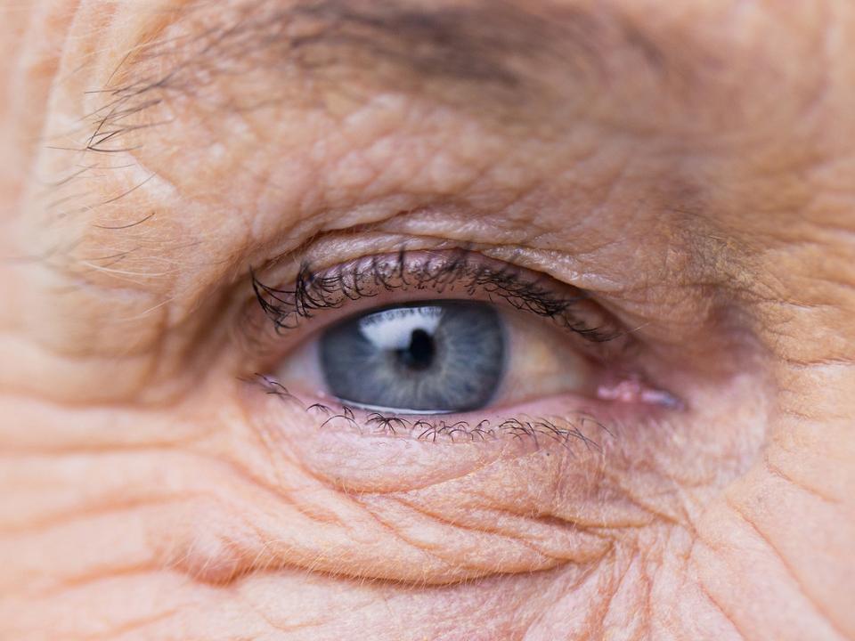 描述眼周光老化现象的图片